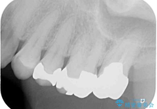 奥歯が外れた ゴールドクラウンによる補綴治療の治療後
