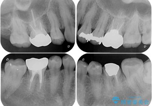 目立つ銀歯を白くしたい 奥歯のセラミック治療の治療前