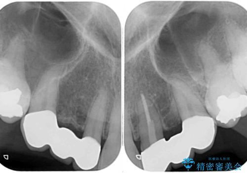 欠損の多い歯列 部分矯正とセラミックブリッジで自然な見た目にの治療後