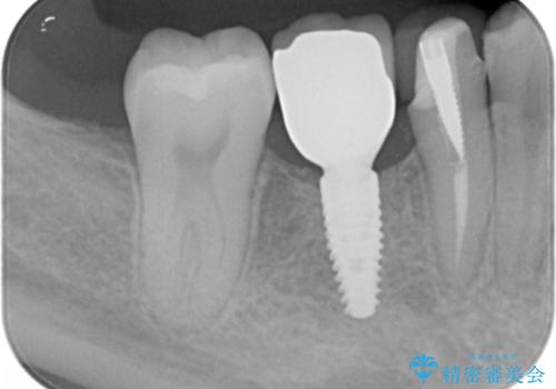 奥歯のインプラントの治療後
