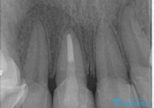 前歯の虫歯　つぎはぎの歯をセラミックにの治療後
