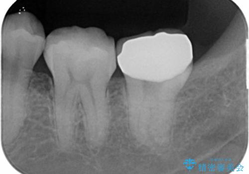 奥歯が黒い セラミッククラウンで綺麗に 30代女性の治療後