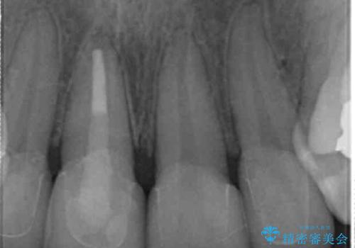 前歯の虫歯 つぎはぎの歯をセラミックにの治療後