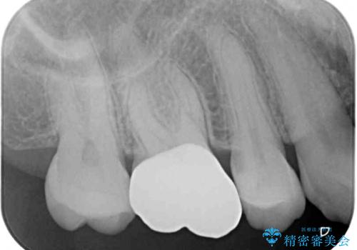奥歯がしみる むし歯と知覚過敏の補綴治療 の治療後