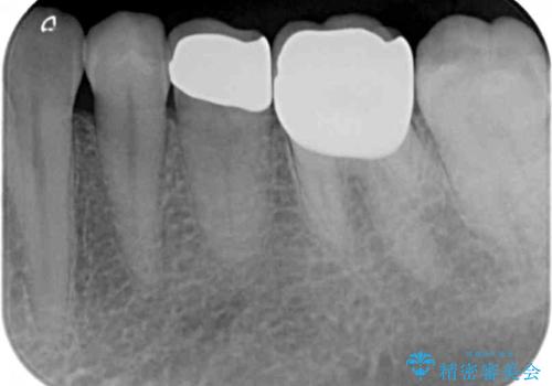 検診で判明した虫歯の再発の治療後