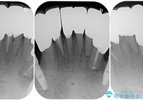 どこで咬んでいいのか分からない インプラント・オーバーデンチャーによる補綴治療の治療後