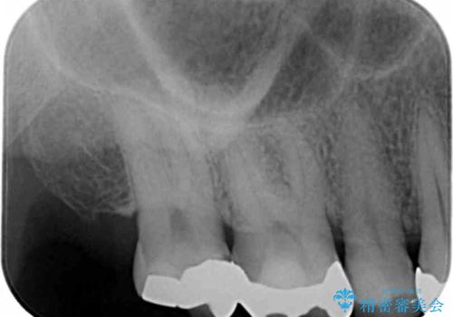噛み心地の良いゴールドインレー修復の治療前