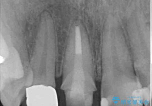 前歯の虫歯 つぎはぎの歯をセラミックにの治療中