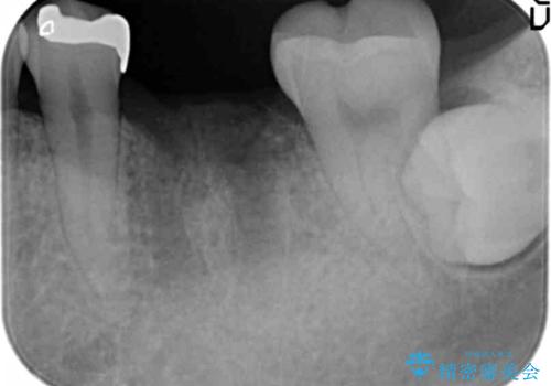 銀歯下の虫歯再発　インプラントによる機能回復の治療中
