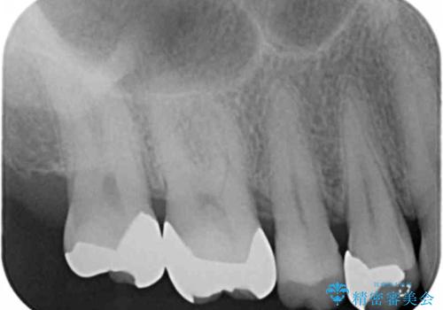 噛み心地の良いゴールドインレー修復の治療後