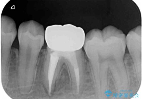 奥歯の被せものが汚れやすい 仮歯のままの歯をセラミッククラウンにの治療後