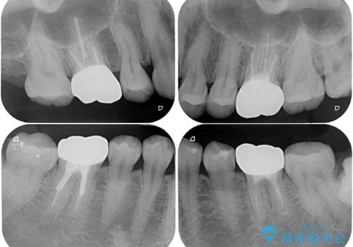 目立つ銀歯を白くしたい 奥歯のセラミック治療の治療後