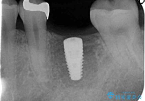 銀歯下の虫歯再発 インプラントによる機能回復の治療中