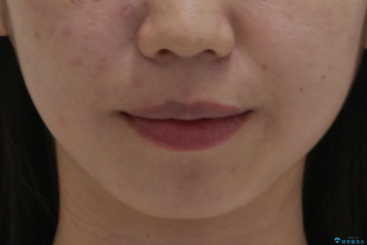 インビザラインで 抜歯矯正の治療後(顔貌)