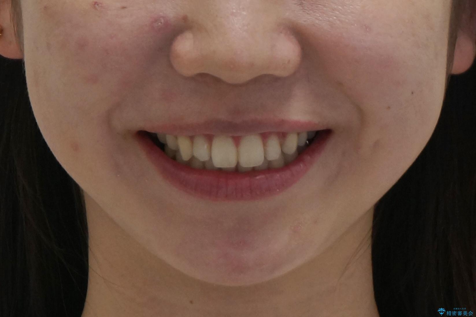 インビザラインで 抜歯矯正の治療後(顔貌)