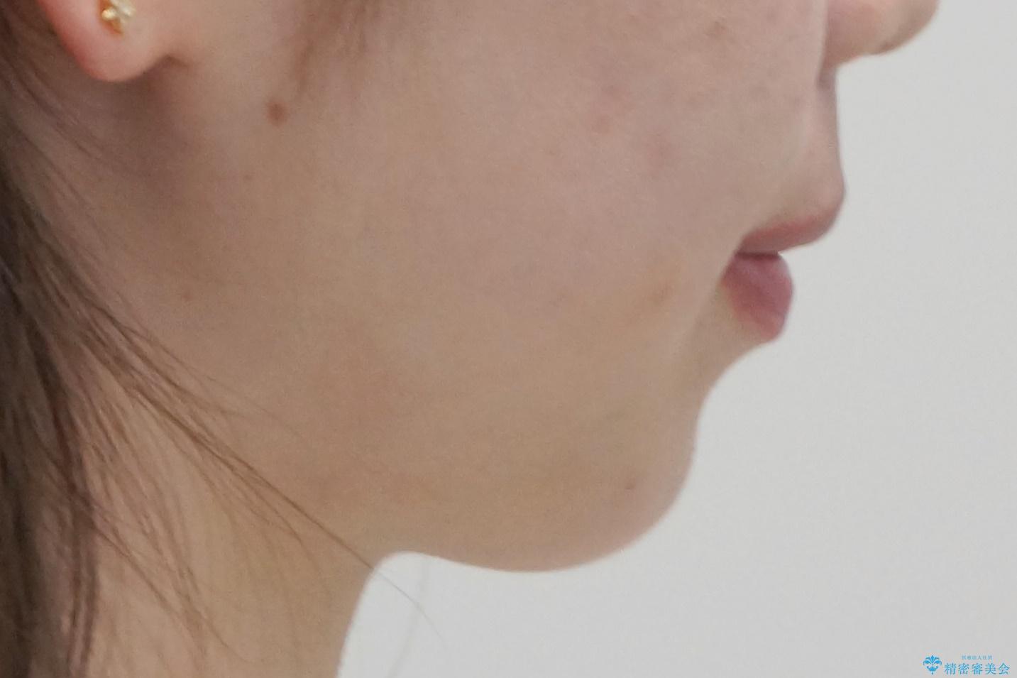 インビザラインで 抜歯矯正の治療後(顔貌)