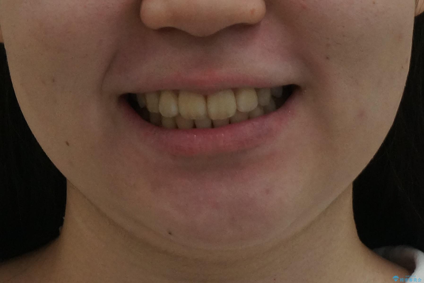 20代女性 前から5番目の歯を抜歯の治療後(顔貌)