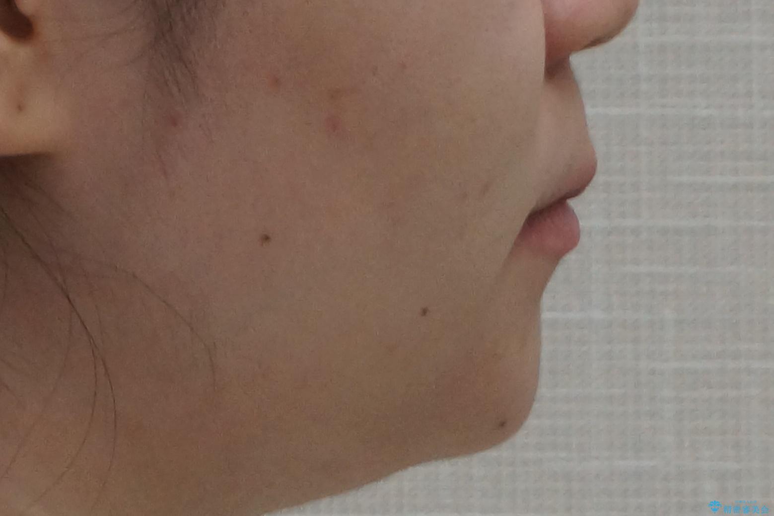 20代女性 前から5番目の歯を抜歯の治療後(顔貌)