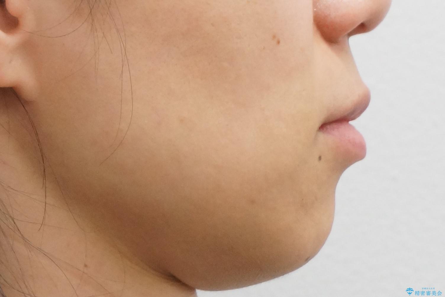 30代女性 前歯のがたつきの治療前(顔貌)