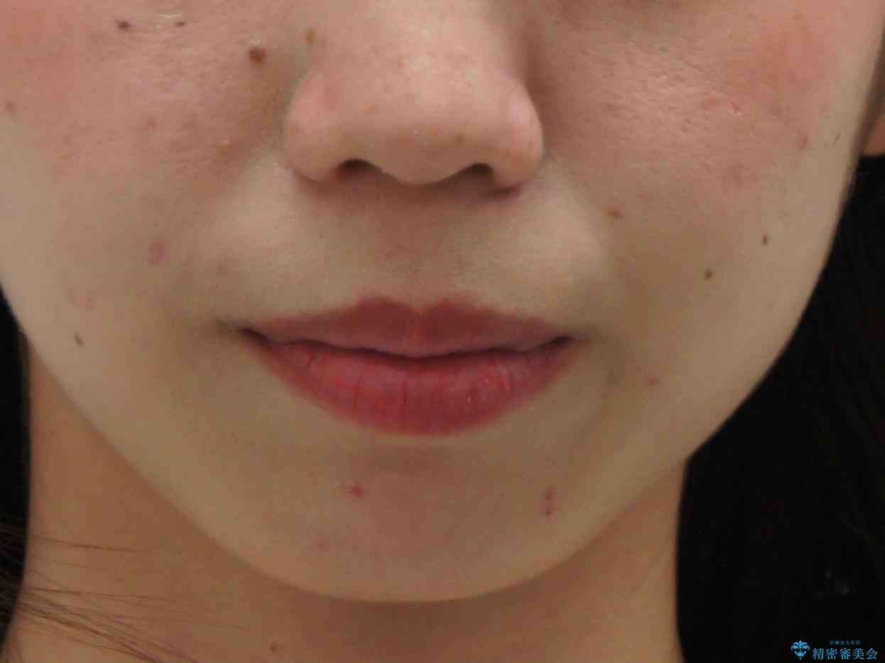 インビザラインで 抜歯矯正の治療前(顔貌)