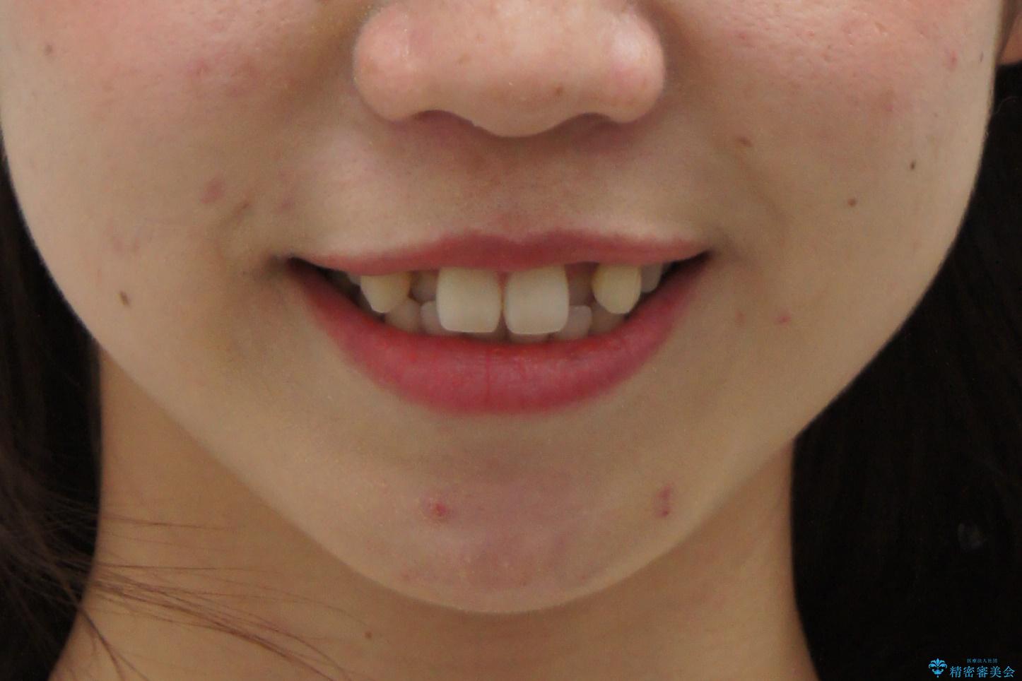 インビザラインで 抜歯矯正の治療前(顔貌)