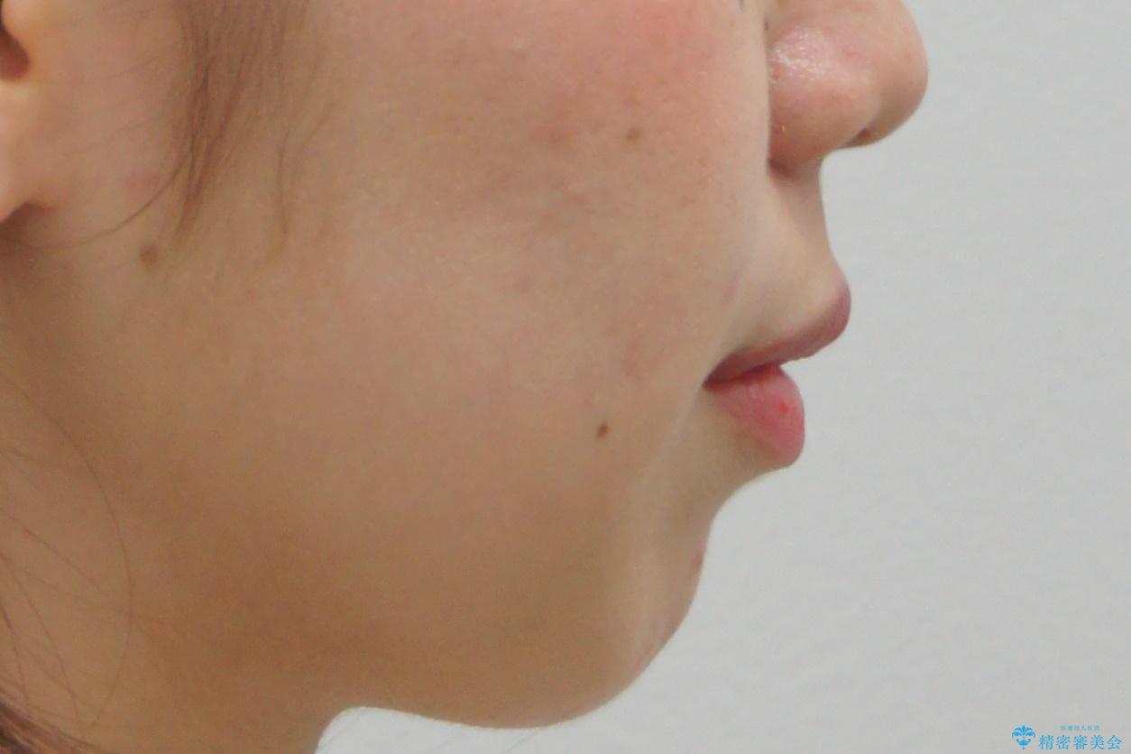 インビザラインで 抜歯矯正の治療前(顔貌)