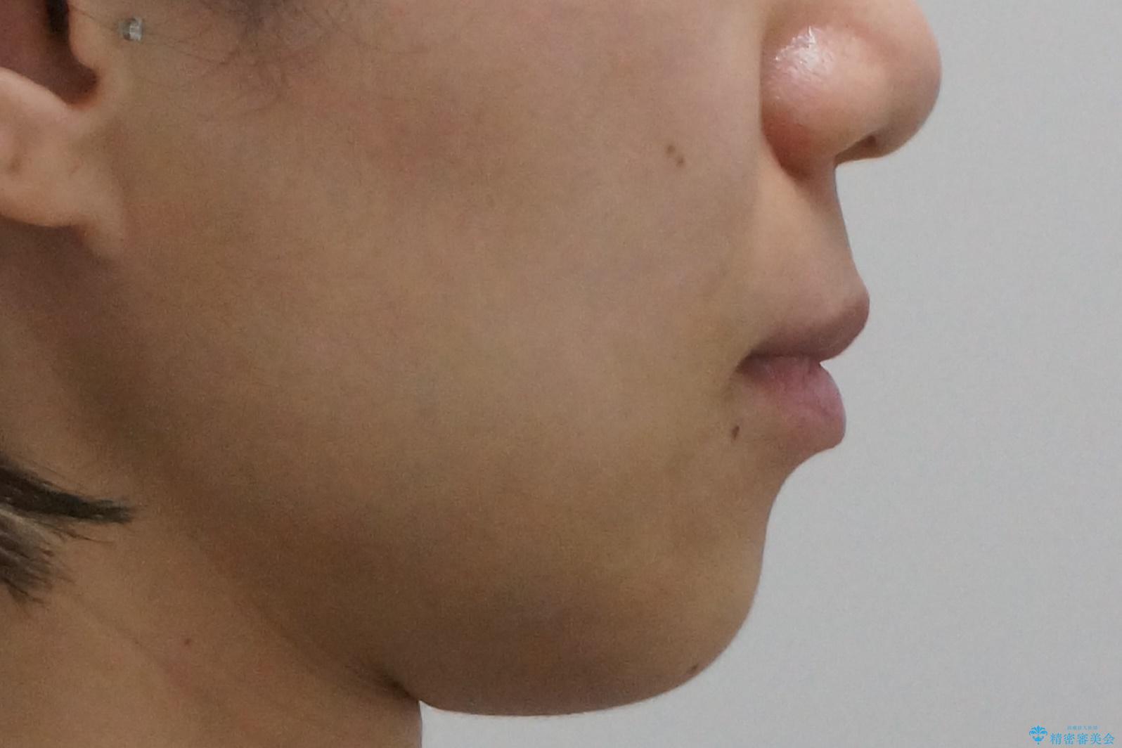 30代女性 前歯のがたつきの治療後(顔貌)