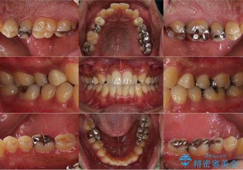 銀歯を無くしたい:適合の良いセラミックでやり替えの症例 治療前