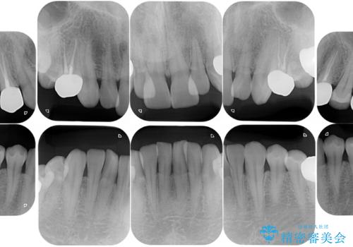 銀歯を無くしたい:適合の良いセラミックでやり替えの治療後