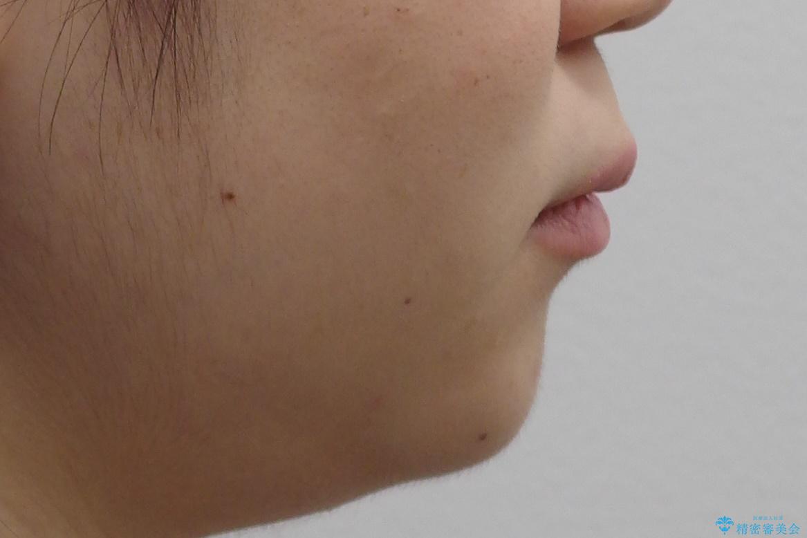 20代女性 前から5番目の歯を抜歯の治療前(顔貌)