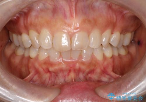 オフィスホワイトニング スペシャルコースの治療前