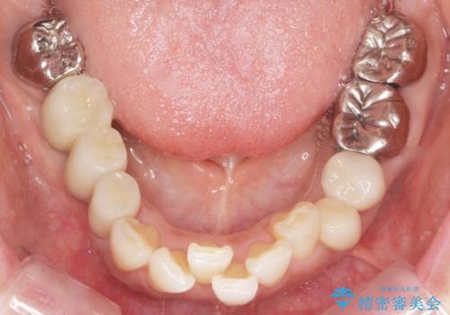 虫歯と歯並びを治したい 50代女性の治療後