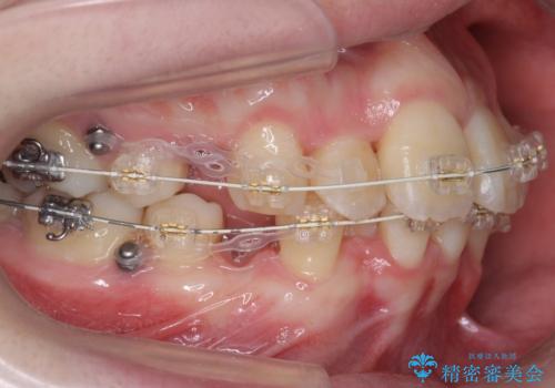 20代女性 前から5番目の歯を抜歯の治療中
