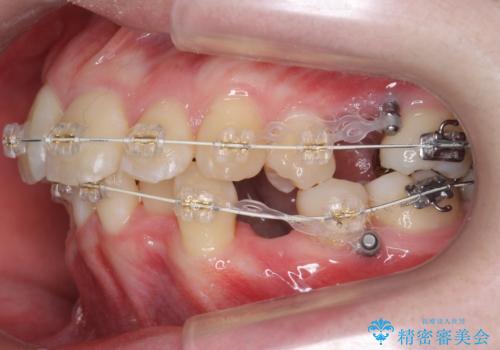 20代女性 前から5番目の歯を抜歯の治療中