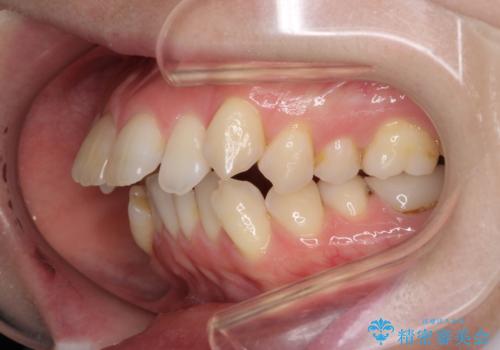 抜歯矯正で閉じにくかった口を閉じやすく改善の治療前