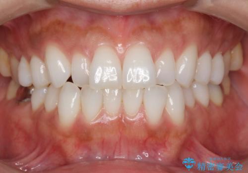 30代女性 前歯のがたつきの症例 治療前
