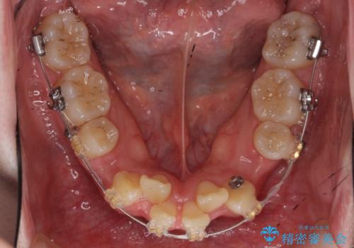 20代女性 前から5番目の歯を抜歯の治療中