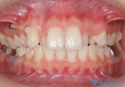 インビザラインで 抜歯矯正の治療中