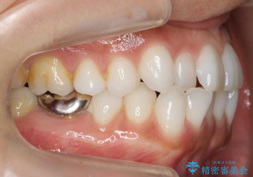 30代女性 前歯のがたつきの治療前
