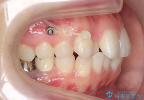 インビザラインで 抜歯矯正の治療中