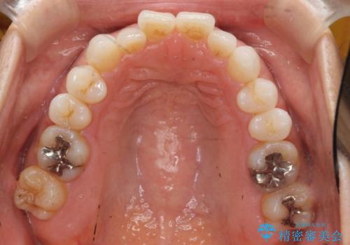 30代女性 前歯のがたつきの治療前