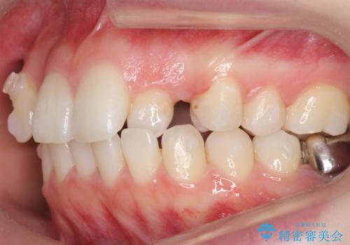 インビザラインで 抜歯矯正の治療中