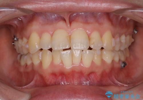 インビザラインで前歯の中心をお顔の中心に合わせるの治療中