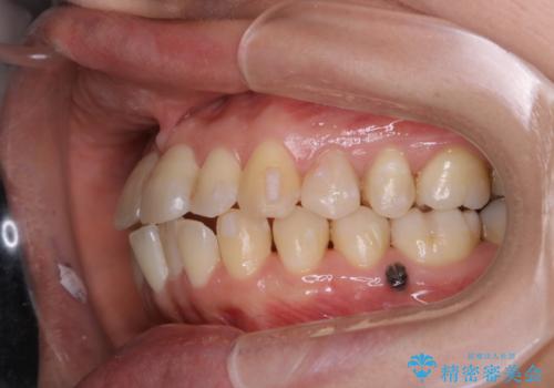 インビザラインで前歯の中心をお顔の中心に合わせるの治療中