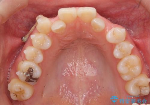 インビザラインで 抜歯矯正の治療中
