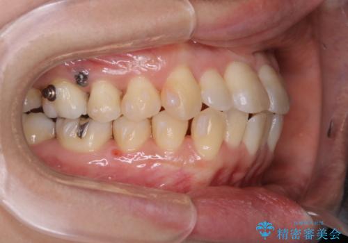 インビザラインで前歯の中心をお顔の中心に合わせるの治療中