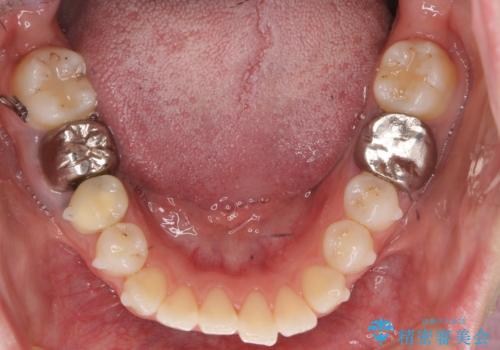 インビザラインで 抜歯矯正の治療中