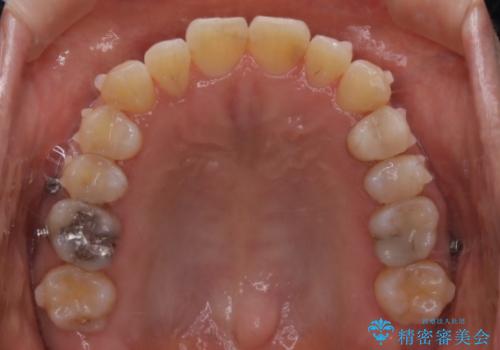 インビザラインで前歯の中心をお顔の中心に合わせるの治療中