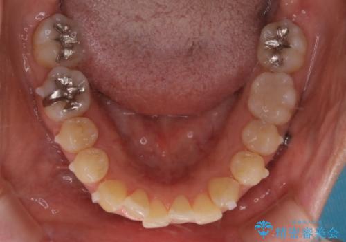 インビザラインで前歯の中心をお顔の中心に合わせるの治療中