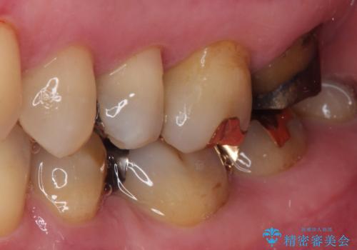 奥歯が外れた ゴールドクラウンによる補綴治療の治療前